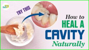 How to Treat Cavities in Baby Teeth Naturally